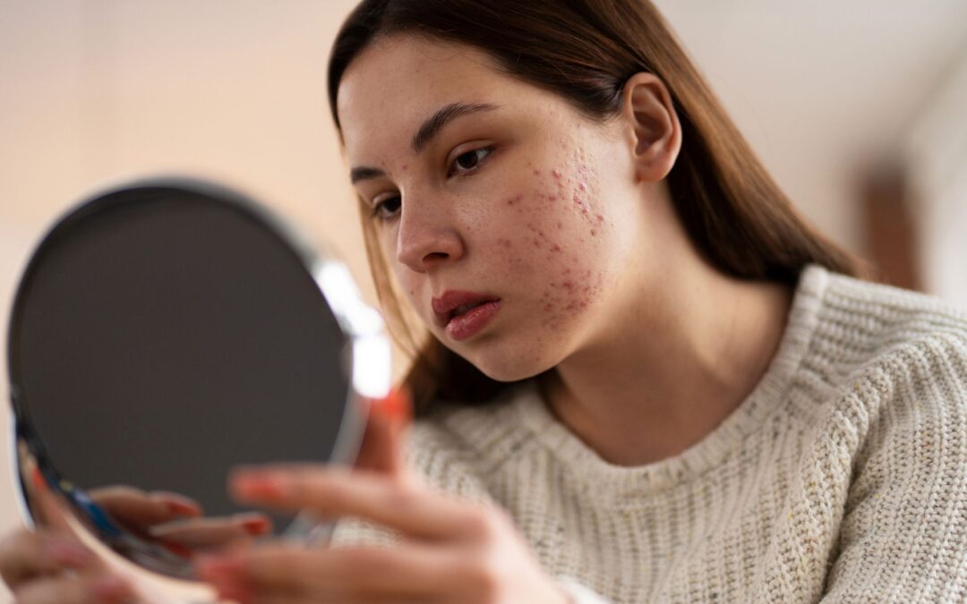 Deciphering the Acne Enigma: The Role of Clinical Trials in Advancing Treatment Breakthroughs